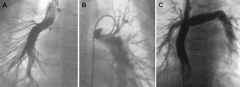 Figure 1 From Connection Of Discontinuous Pulmonary Arteries In