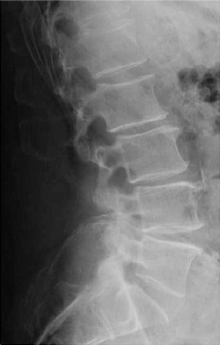 Standing Lateral Lumbar Radiograph Obtained 2 Weeks Following The Download Scientific Diagram