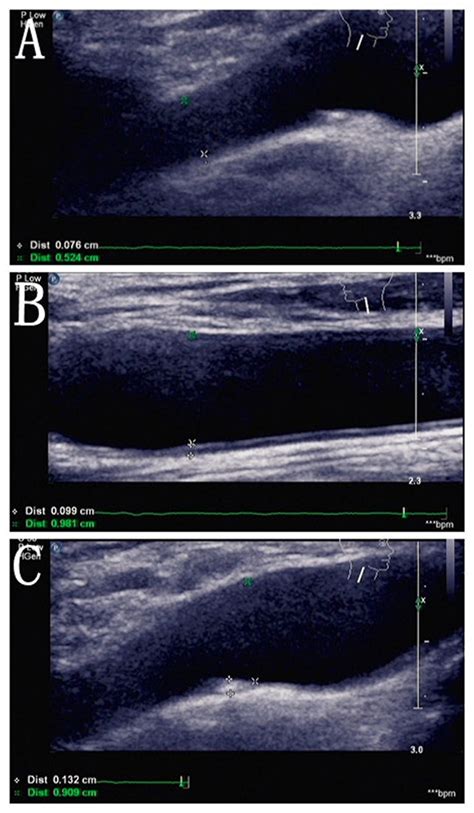 Carotid Ultrasound Image Representing Thickening Or Plaque Of Carotid Download Scientific