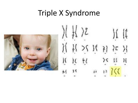 Ppt Human Sex Chromosome Abnormalities Powerpoint Presentation Free Download Id2875567