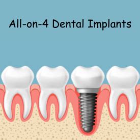 All On Dental Implants Benefits Procedure Costs Results