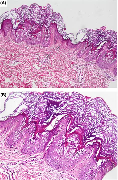 Adult‐onset epidermal nevus with epidermolytic hyperkeratotic pattern