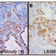 Immunohistochemical Detection Of A Egfr Exon E A Deletion