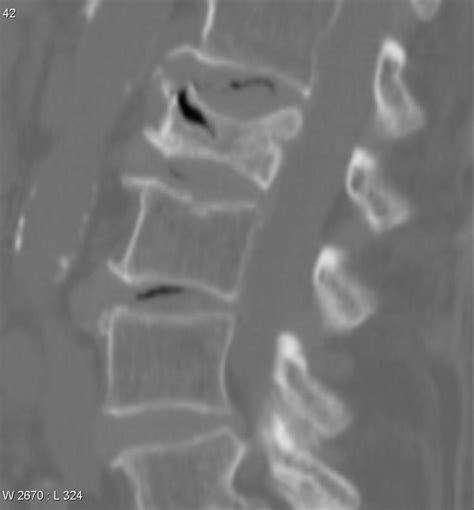 Osteoporotic Vertebral Compression Fracture Spine Orthobullets