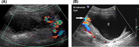 Ovarian Torsion Ultrasound Whirlpool Sign