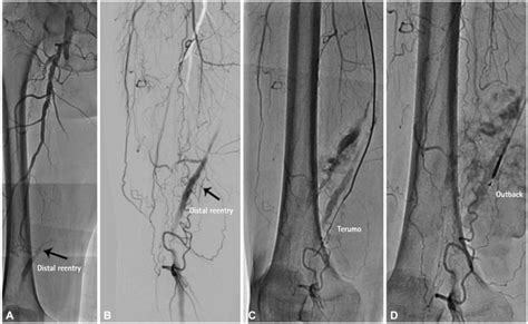 Right Superficial Femoral Artery