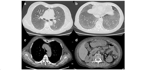 Chest And Abdominal Ct A B Showed Ground Glass Opacities With Download Scientific Diagram