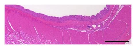 Mucosal Hyperplasia And Squamous Cell Carcinoma Induced By C Albicans