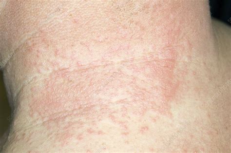 Shingles Rash On The Neck Stock Image C0085782 Science Photo Library