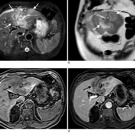 A Year Old Man With Primary Hepatic Lymphoma A Axial Fat