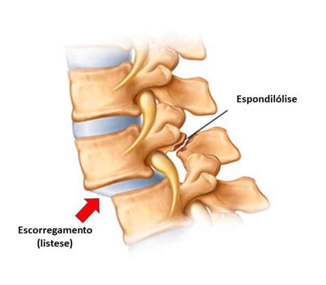 Espondilolistese Dr Ricardo Teixeira Especialista Em Coluna
