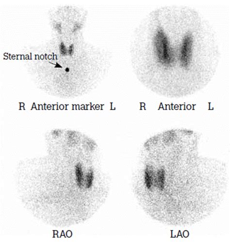 Nuclear Medicine Thyroid Uptake Scan Top 3 Things To Know