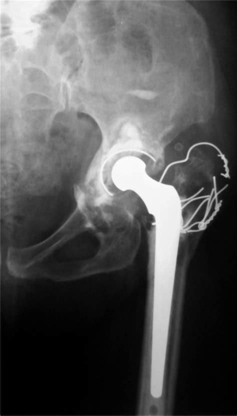 Acetabular Reconstruction In Patients With Low And High Dislocation Bone And Joint