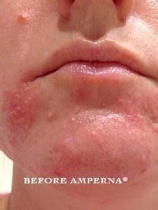 Perioral Dermatitis Artofit