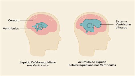 Hidrocefalia De Press O Normal Dr Bruno Colodetti