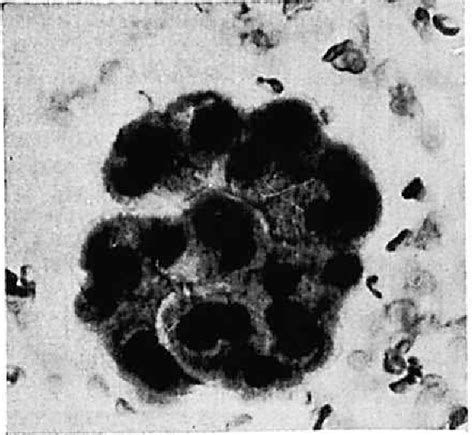 Figure 2 From Il Valore Della Citologia Urinaria Nella Diagnosi Delle