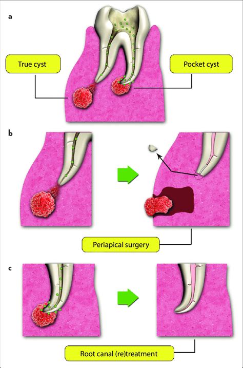 Periapical Granuloma Vs Cyst