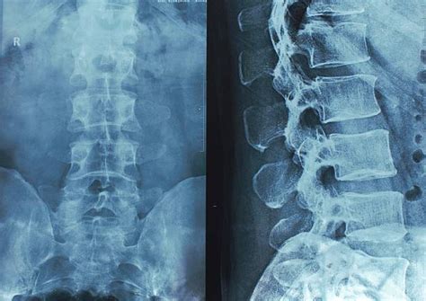 Spinal Cord Injury Stock Photos Pictures And Royalty Free Images Istock