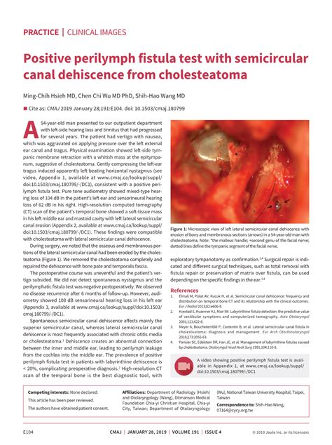 Positive Perilymph Fistula Test With Semicircular Canal Dehiscence From Cholesteatoma Docslib