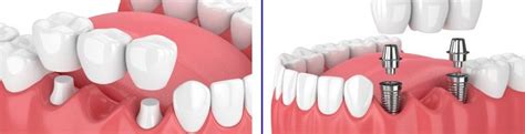 Benefits Of Dental Implants Over Fixed Bridge The Smile Makeover