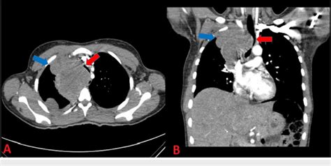 Computed Tomography Angiography Cta Of The Chest Axial And Sagittal