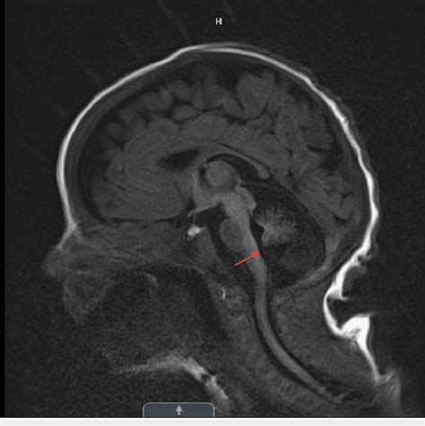 Magna Cisterna Magna Symptoms At Terry Summers Blog