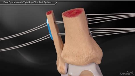 Dual Syndesmosis Tightrope Implant System Youtube