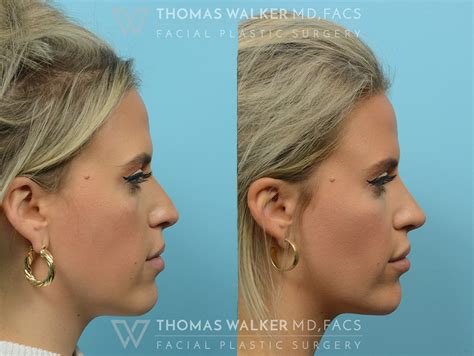 Liquid Rhinoplasty Before And After Photos Atlanta Ga