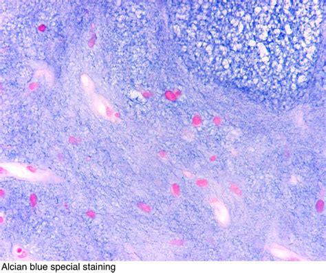 Pathology Outlines Myxoid Liposarcoma