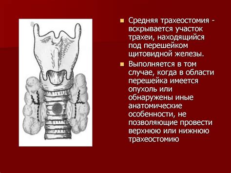Трахеостомия - презентация онлайн
