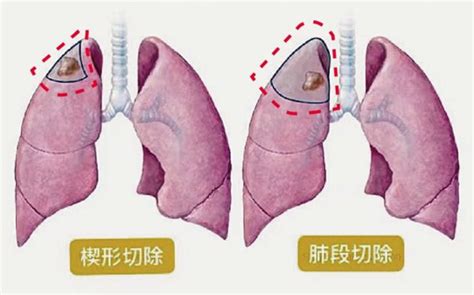 谁说肺癌是绝症？早期肺癌是能被治愈的！ 微医（挂号网）