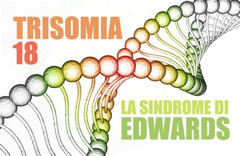 Trisomia Cos La Sindrome Di Edwards Ability Channel