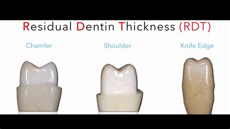 Finish Line Geometry And Soft Tissue Management In Fixed Tooth