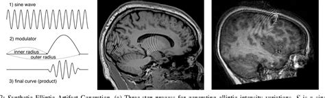 Figure From Localized Motion Artifact Reduction On Brain Mri Using