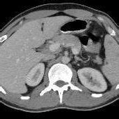 An Abdominal Ct Scan Showing Multiple Hypodense Nodules In The Spleen