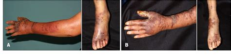 Figure 1 From Treatment Of Disseminated Classic Type Of Kaposis