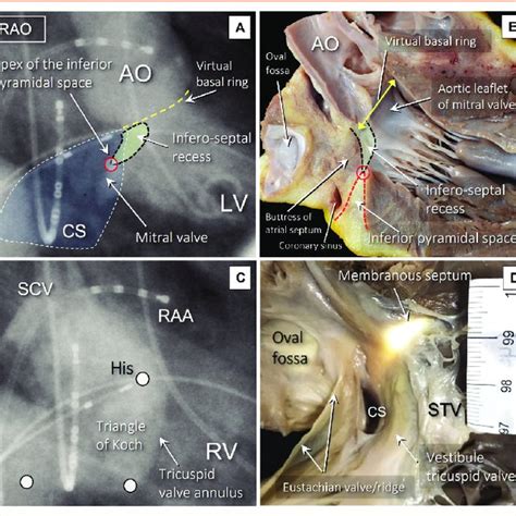 Triangle Of Koch Inferoseptal Recess And Inferior Pyramidal Space Download Scientific Diagram