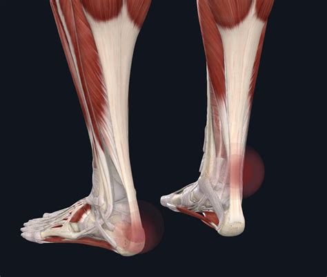 What Is Achilles Tendinopathy The Physios