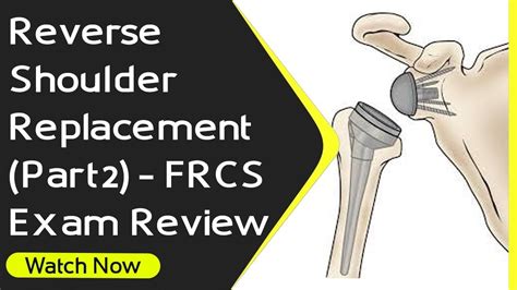 Reverse Shoulder Replacement Part 2 FRCS Exam Review Managing