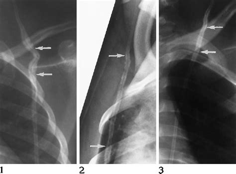 Figure 1 From Ventriculoperitoneal Shunts Subcutaneous Catheter