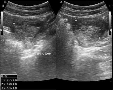 Corpus Luteum Cyst Ultrasound