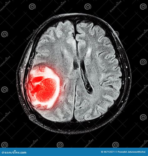 MRI Brain Show Brain Tumor At Right Parietal Lobe Royalty-Free Stock ...