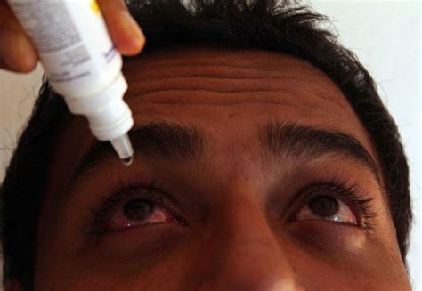 Aumentan 14 Los Casos De Conjuntivitis En El Estado