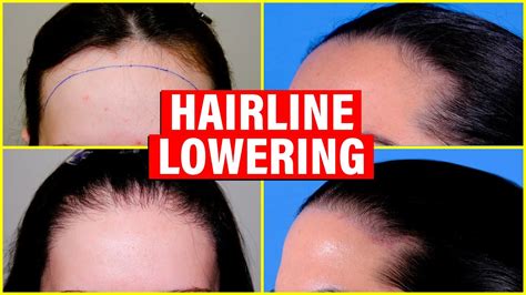 Hairline Lowering Hair Transplant Vs Surgical Hairline Advancement