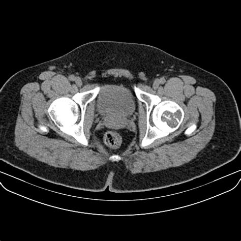 Chondroblastoma Radiology Case