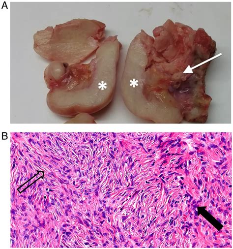 Ovarian Fibromatosis The Black Garland Sign” Radiología English