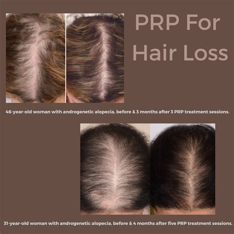 Platelet Rich Plasma Prp For Hair Loss — Dr Heather Friedman Nd Lac