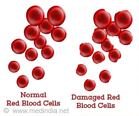 G6Pd Deficiency