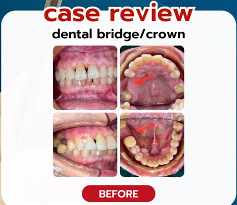 Review Of Dental Bridge Crown Case Chiangmai Hospital Tel 053 225 222