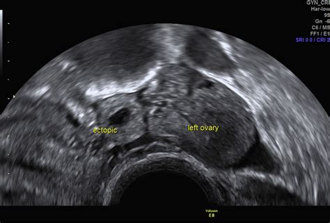 Ultrasound In Obstetrics And Gynaecology Obstetrics Gynaecology And Reproductive Medicine